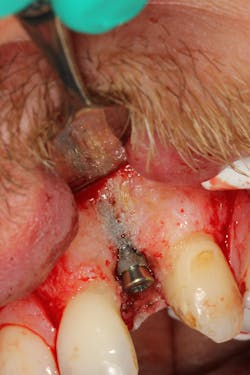 Figure 2b: Flap surgery of the implant showing fenestration of the implant through the buccal wall due to deficient bone volume Figure 2b: Flap surgery of the implant showing fenestration of the implant through the buccal wall due to deficient bone volume