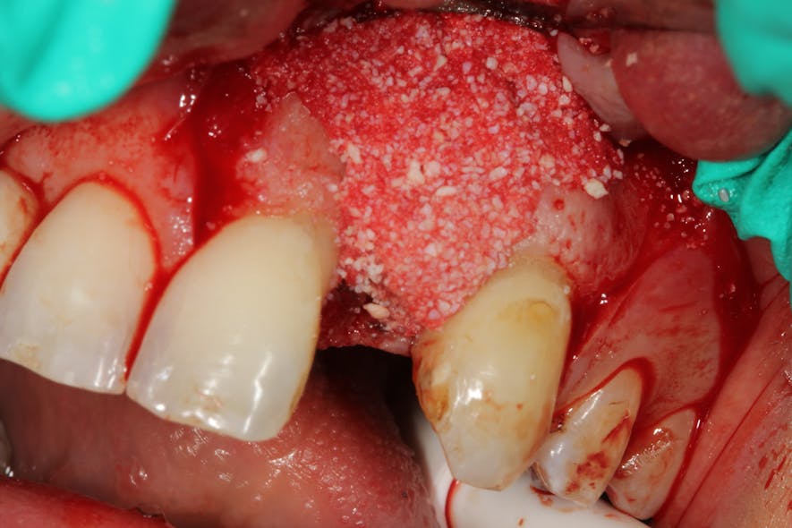 Figure 2c: Buccal bone of implant was augmented with Geistlich Bio-Oss Collagen to save the implant from explantation