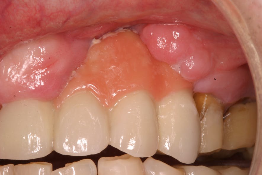 Figure 3: Prosthetic (pink) porcelain needed on an implant bridge to mask hard- and soft-tissue loss