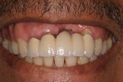 Figure 3a: Soft- and hard-tissue loss on a tooth-borne bridge after extraction without grafting, resulting in an unesthetic restoration Figure 3a: Soft- and hard-tissue loss on a tooth-borne bridge after extraction without grafting, resulting in an unesthetic restoration