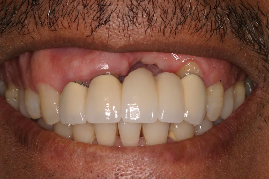 Figure 3a: Soft- and hard-tissue loss on a tooth-borne bridge after extraction without grafting, resulting in an unesthetic restoration