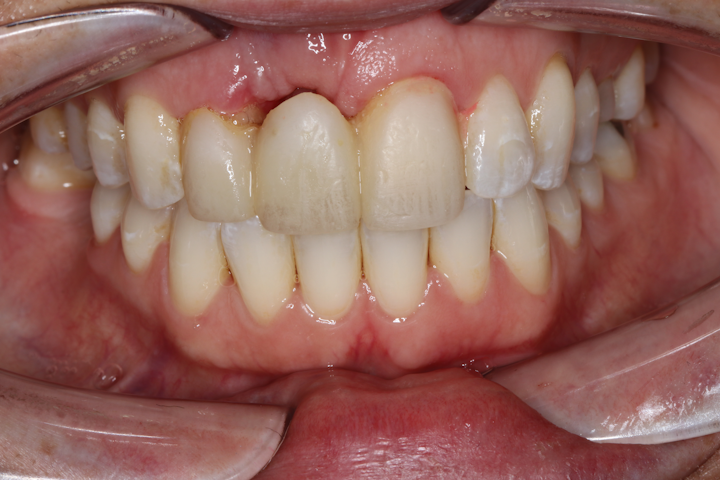 Bone grafting after tooth removal: Why, when, and what to use | Perio-Implant Advisory Bone grafting after tooth removal: Why, when, and what to use | Perio-Implant Advisory