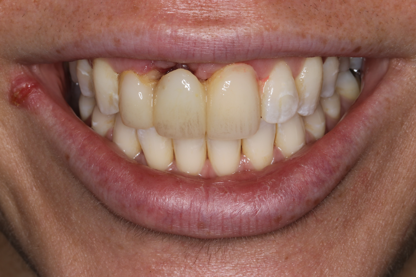 Bone Grafting After Tooth Removal Why When And What To Use Perio bone-grafting-after-tooth-removal-why-when-and-what-to-use-perio