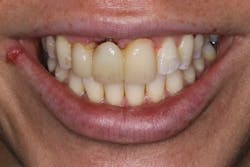 Figure 4a: Collapse of hard and soft tissue under fixed bridge after tooth extraction without grafting. Figure 4a: Collapse of hard and soft tissue under fixed bridge after tooth extraction without grafting.