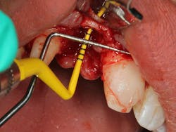 Figure 4b: Severe defect with horizontal and vertical bone loss Figure 4b: Severe defect with horizontal and vertical bone loss