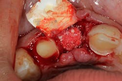 Figure 4c: Pontic site development with Geistlich Bio-Oss Collagen and Geistlich Bio-Gide Figure 4c: Pontic site development with Geistlich Bio-Oss Collagen and Geistlich Bio-Gide