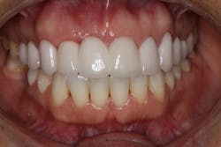 Figure 4d: Final bridge insertion after pontic site development. Figure 4d: Final bridge insertion after pontic site development.
