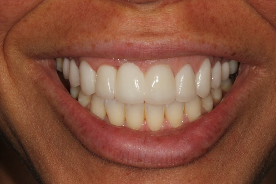 Figure 4e: Final picture of smile