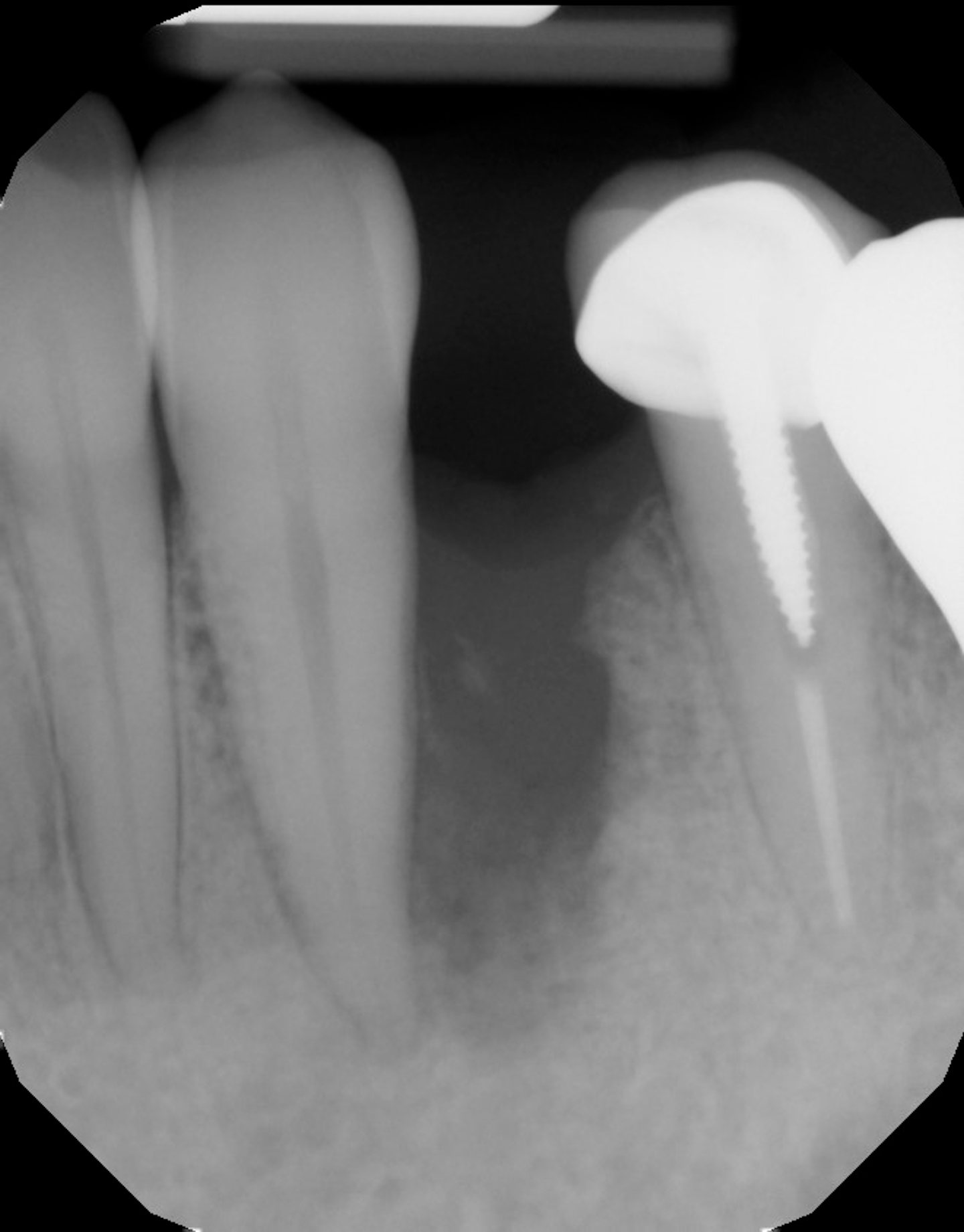 Bone Grafting After Tooth Removal Why When And What To Use Perio Implant Advisory