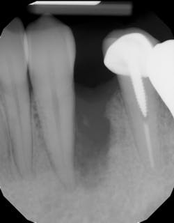 Figure 5a: Radiograph of severe bone defect after tooth extraction with bone loss affecting adjacent teeth Figure 5a: Radiograph of severe bone defect after tooth extraction with bone loss affecting adjacent teeth