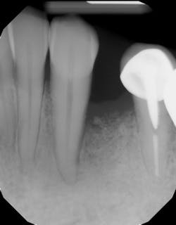 Figure 5c: 12 months postoperative radiograph of healing Figure 5c: 12 months postoperative radiograph of healing
