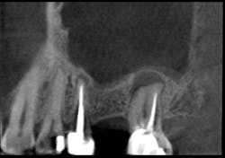 Figure 6: Image of tooth with large infection that will require bone graft after extraction to keep sinus intact and from pneumatizing Figure 6: Image of tooth with large infection that will require bone graft after extraction to keep sinus intact and from pneumatizing
