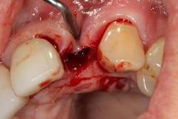 Figure 10b: Type 2 socket after tooth extraction, showing loss of buccal plate