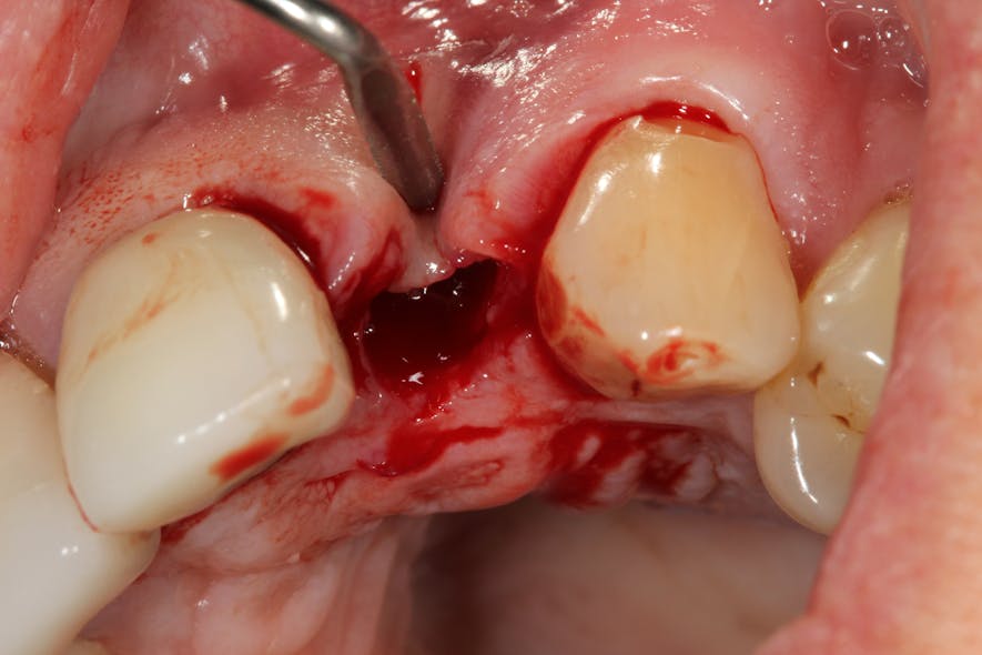 Figure 10b: Type 2 socket after tooth extraction, showing loss of buccal plate