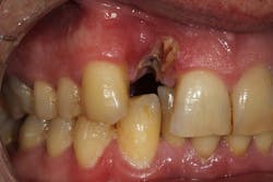 Figure 11: Type 3 socket with buccal plate and soft-tissue loss Figure 11: Type 3 socket with buccal plate and soft-tissue loss