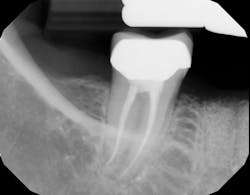 Figure 12a: Radiograph of site No. 30 12 months after bone graft Figure 12a: Radiograph of site No. 30 12 months after bone graft