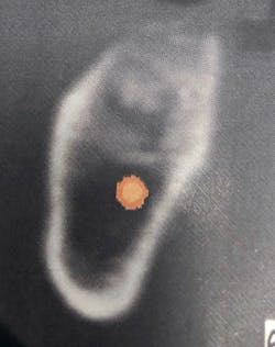 Figure 12b: CT scan of bone graft showing poor graft healing and fibrous encapsulation Figure 12b: CT scan of bone graft showing poor graft healing and fibrous encapsulation