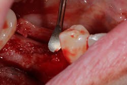 Figure 12c: Surgery of graft with poor healing and need to be removed and regrafted Figure 12c: Surgery of graft with poor healing and need to be removed and regrafted