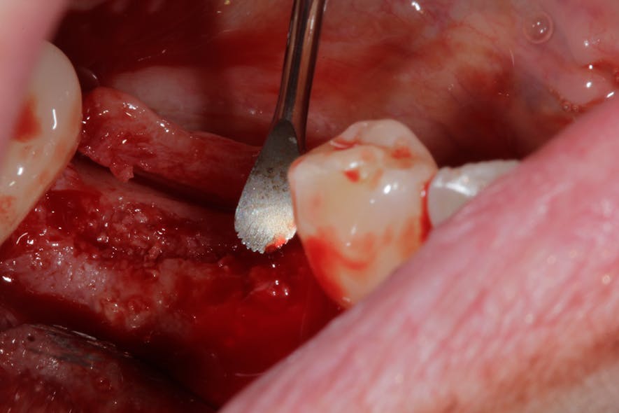 Figure 12c: Surgery of graft with poor healing and need to be removed and regrafted