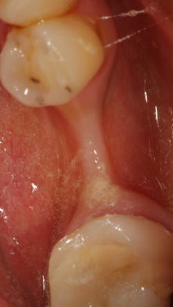 Figure 1: Site No. 29 was extracted one year prior to the photo, resulting in severe ridge resorption and the need for ridge augmentation prior to dental implant treatment.