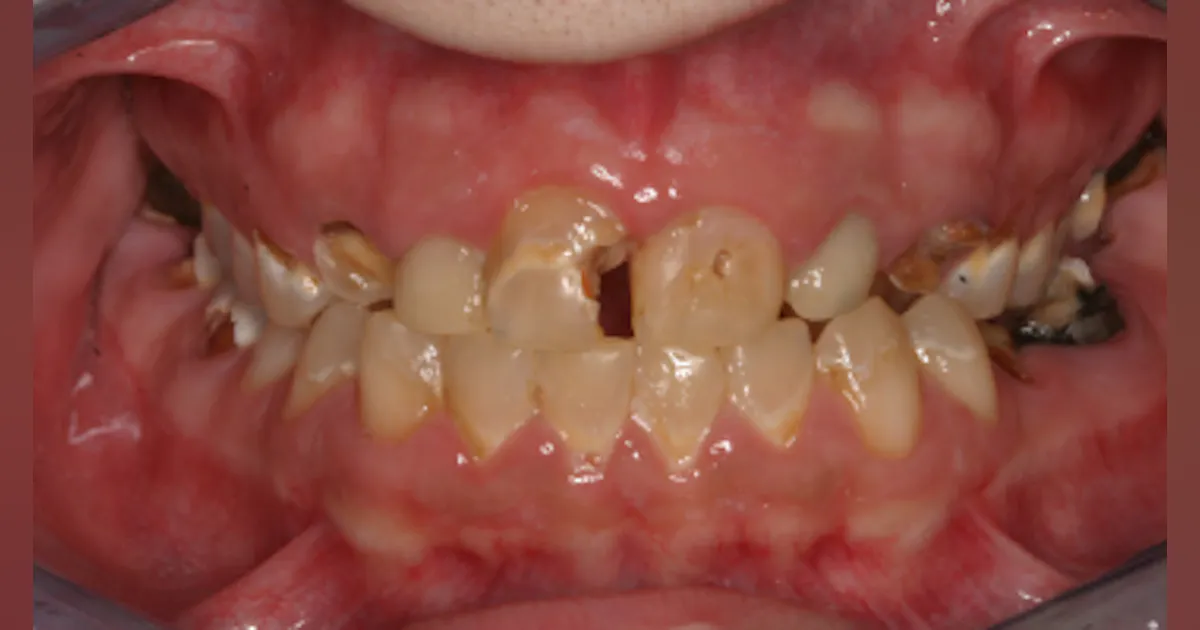 Vaping and oral health: It's worse than you think | Perio Implant Advisory Vaping and oral health: It's worse than you think | Perio Implant Advisory