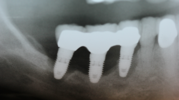 Radiograph of an implant cluster failure