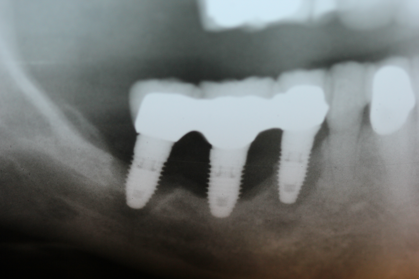 Failing dental implants Ascertaining the etiology behind a sudden