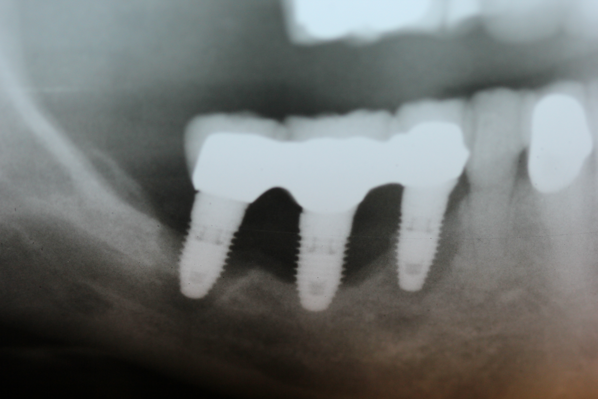 Failing dental implants Ascertaining the etiology behind a sudden