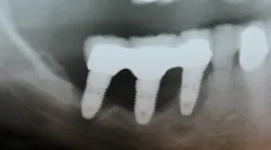 Radiograph of an implant cluster failure