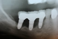 Radiograph of an implant cluster failure Radiograph of an implant cluster failure