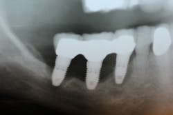 Radiograph of an implant cluster failure