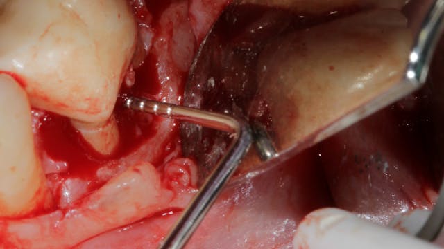 Saving teeth: Revisiting molar furcation treatment with advanced