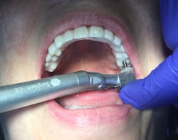 Figure 2: Right-angle prosthetic implant driver for hard-to-reach areas Figure 2: Right-angle prosthetic implant driver for hard-to-reach areas