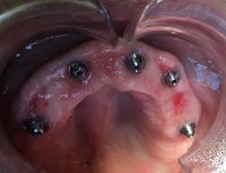 Figure 3: Assessing health of gingiva under the prosthesis Figure 3: Assessing health of gingiva under the prosthesis