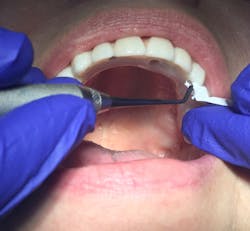 Figure 7: Packing PTFE tape firmly into the access holes Figure 7: Packing PTFE tape firmly into the access holes