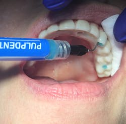 Figure 8: Briefly etching with 37% phosphoric acid to clean access holes Figure 8: Briefly etching with 37% phosphoric acid to clean access holes