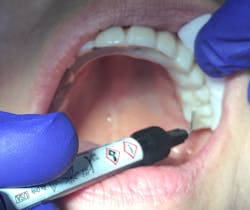 Figure 10: Restoring access holes with flowable composite Figure 10: Restoring access holes with flowable composite