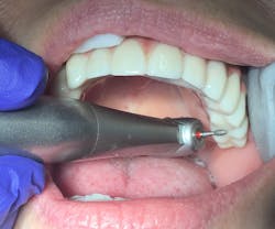 Figure 11: Finishing flowable with fine football diamond bur Figure 11: Finishing flowable with fine football diamond bur