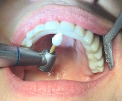 Figure 12: Polishing flowable with disposable composite polishing point Figure 12: Polishing flowable with disposable composite polishing point