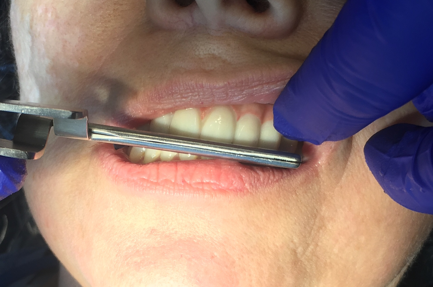 Maintaining fullarch dental implant prosthetics PerioImplant Advisory