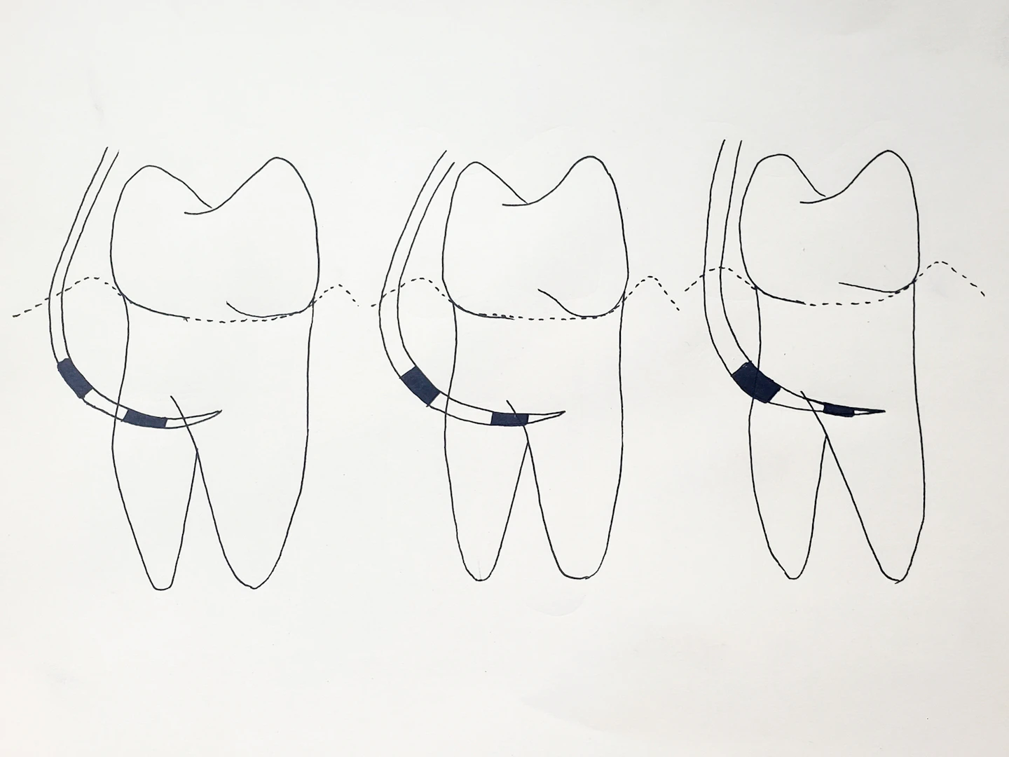 Hamp Classification Saving teeth: Revisiting molar furcation treatment with advanced ...