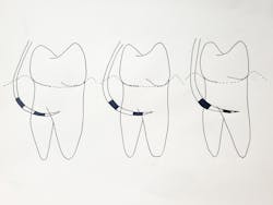 Figure 1: Modified Hamp Furcation Classification I–III Figure 1: Modified Hamp Furcation Classification I–III