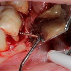 Figure 2: Class II furcation showing a narrow furcation entrance and the inability of conventional instrumentation to access furcation Figure 2: Class II furcation showing a narrow furcation entrance and the inability of conventional instrumentation to access furcation