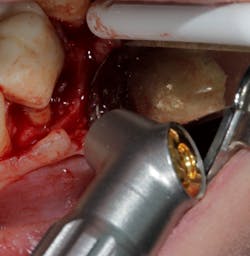 Figure 3: Laser beam capable of entering furcation since it is focused to be smaller than 1 mm Figure 3: Laser beam capable of entering furcation since it is focused to be smaller than 1 mm