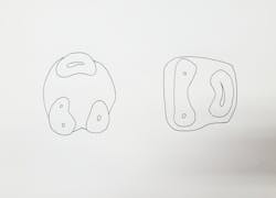 Figure 4: Image showing root concavities in furcation Figure 4: Image showing root concavities in furcation