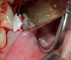 Figure 5: Bone graft (Geistlich Bio-Oss Collagen) that has scaffolding properties as well as the ability to be saturated with growth factors Figure 5: Bone graft (Geistlich Bio-Oss Collagen) that has scaffolding properties as well as the ability to be saturated with growth factors