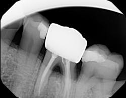 Figure 7: Radiograph demonstrating a mandibular molar furcation that was slated for extraction Figure 7: Radiograph demonstrating a mandibular molar furcation that was slated for extraction