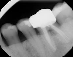 Figure 8: Radiograph of tooth shown in Figure 7 one year after regenerative treatment, demonstrating radiographic evidence of furcation fill Figure 8: Radiograph of tooth shown in Figure 7 one year after regenerative treatment, demonstrating radiographic evidence of furcation fill