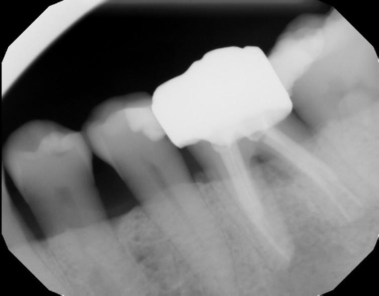 Figure 8: Radiograph of tooth shown in Figure 7 one year after regenerative treatment, demonstrating radiographic evidence of furcation fill