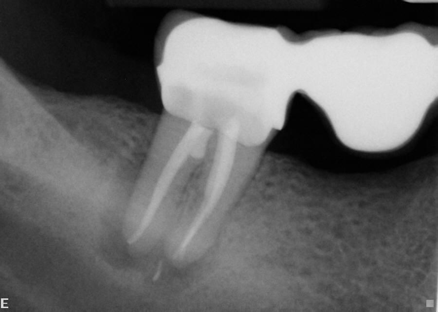 Periapical lesions Does the size of an endodontic lesion play a role